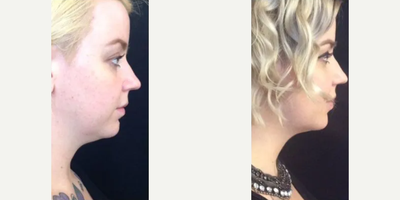 Kybella before and after photo