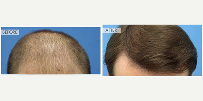 NeoGraft before and after photo