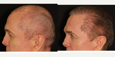 NeoGraft before and after photo