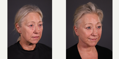Brow Lift before and after photo