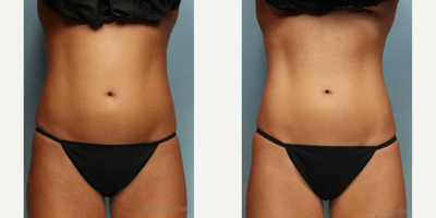 CoolSculpting before and after photo