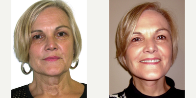 Facelift before and after photo