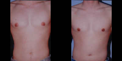 Gynecomastia Surgery before and after photo