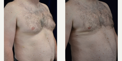 Gynecomastia Surgery before and after photo
