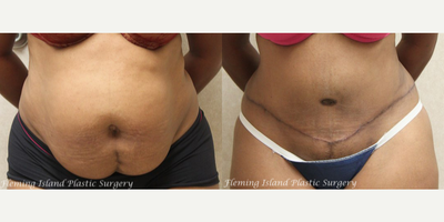 Tummy Tuck before and after photo