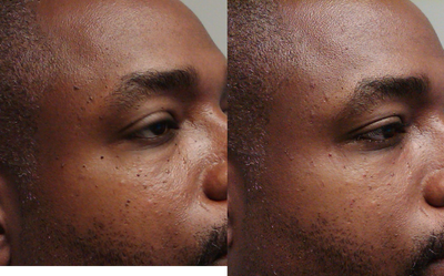 Mole Removal before and after photo