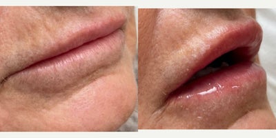 PRP Injections before and after photo
