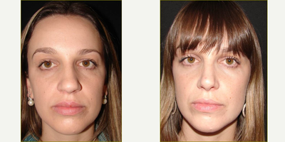 Rhinoplasty before and after photo