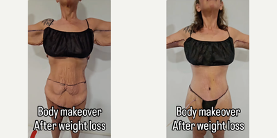 Tummy Tuck before and after photo