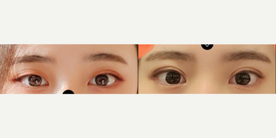 Double Eyelid Surgery before and after photo