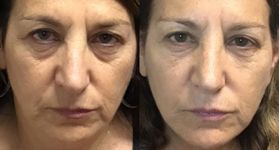 Dysport before and after photo