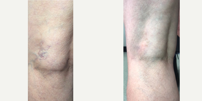 Excel V before and after photo