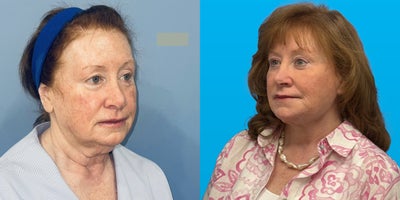 Eyelid Surgery before and after photo