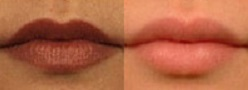 Lip Fillers before and after photo