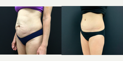Tummy Tuck before and after photo