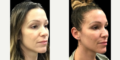 Voluma before and after photo