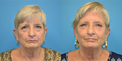 Eyelid Surgery before and after photo