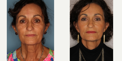 Facelift before and after photo