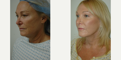 Facelift before and after photo