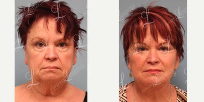 Facelift before and after photo