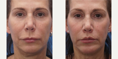 FaceTite before and after photo