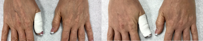 Hand Rejuvenation before and after photo