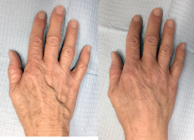 Juvederm before and after photo