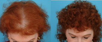 PRP for Hair Loss before and after photo