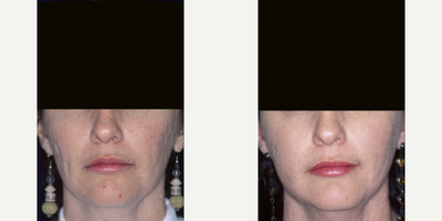 Dermal Fillers before and after photo