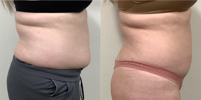 Emsculpt before and after photo