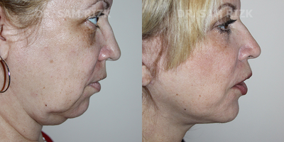 Facelift before and after photo