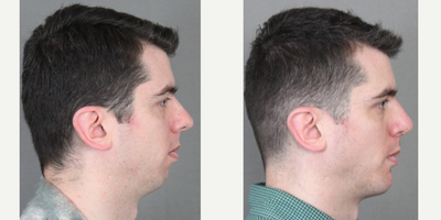 Genioplasty before and after photo