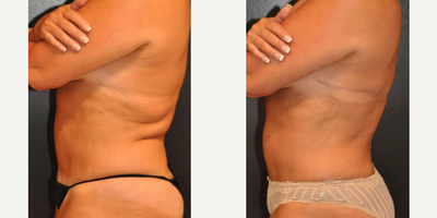 Liposuction before and after photo