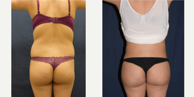 Brazilian Butt Lift before and after photo