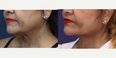 Chin Liposuction before and after photo