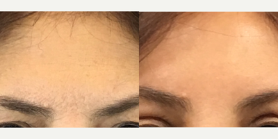 CO2 Laser before and after photo