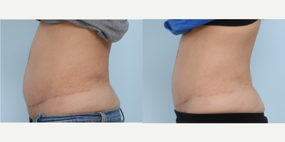 CoolSculpting before and after photo