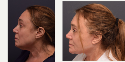 Facelift before and after photo