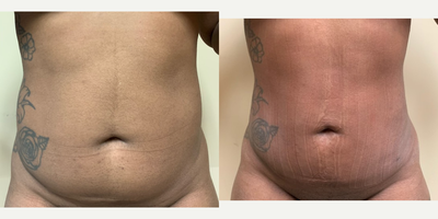 i-Lipo before and after photo