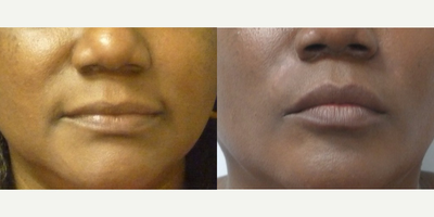 Juvederm before and after photo