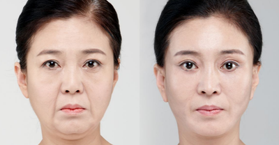 SMAS Facelift before and after photo
