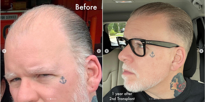 Hair Transplant before and after photo