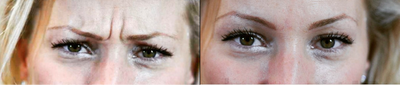 Botox before and after photo