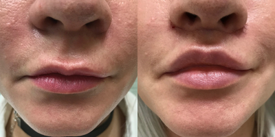 Lip Lift before and after photo