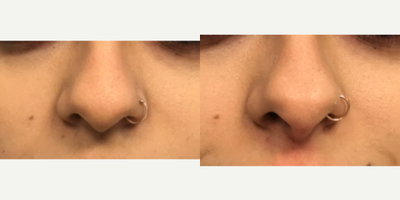 Nonsurgical Nose Job before and after photo