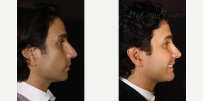 Rhinoplasty before and after photo