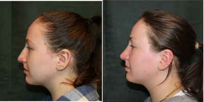 Rhinoplasty before and after photo