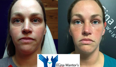 Voluma before and after photo