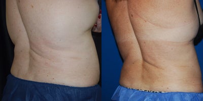 CoolSculpting before and after photo