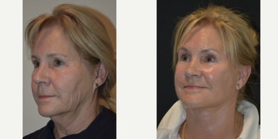 Deep Plane Facelift before and after photo